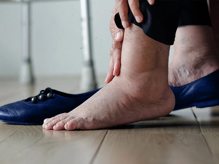 Toms River Diabetic Ulcer Treatment