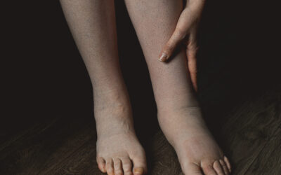 Lymphedema