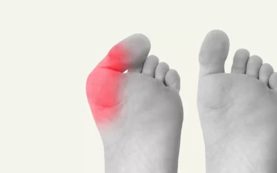 When Is Bunion Surgery Necessary?