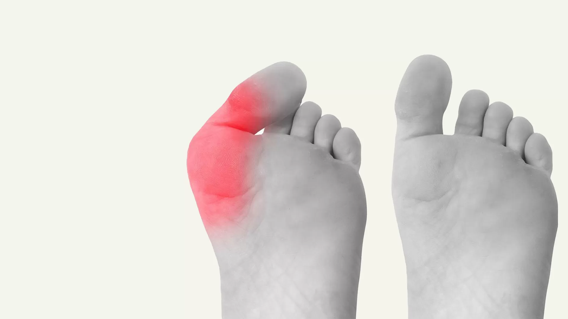 What-is-Bunion-surgery Bunion Surgery Necessary