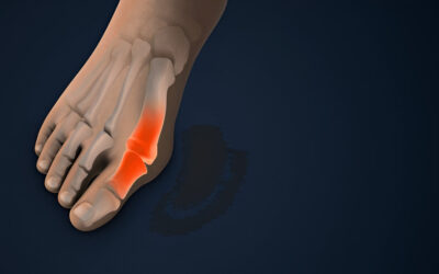 Understanding Bunions: Should You Consider Surgery?