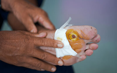 How to Prevent Diabetic Foot Ulcers Before They Start