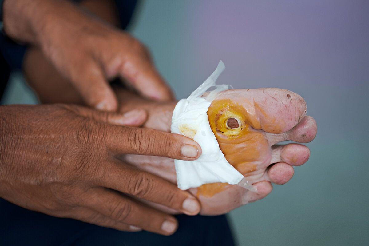 How to Prevent Diabetic Foot Ulcers Before They Start